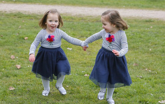 توأم ملتصق تتشابهان في كل شيء رغم فصلهما عند الولادة صورة رقم 7 توأم ملتصق تتشابهان في كل شيء رغم فصلهما عند الولادة صورة رقم 7