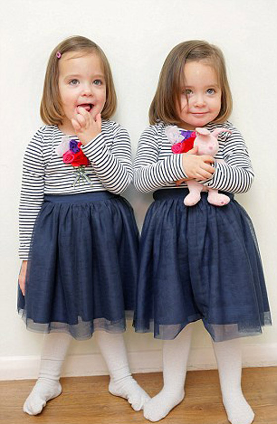 توأم ملتصق تتشابهان في كل شيء رغم فصلهما عند الولادة صورة رقم 9 توأم ملتصق تتشابهان في كل شيء رغم فصلهما عند الولادة صورة رقم 9