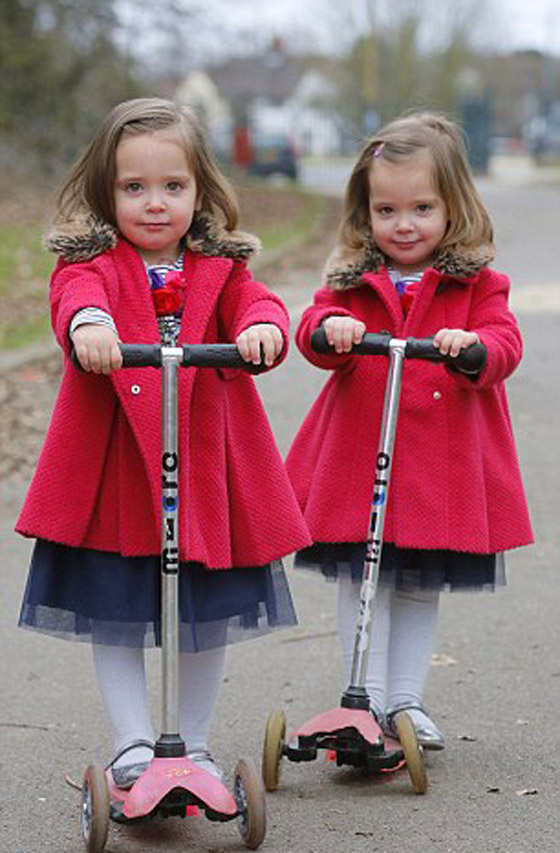 توأم ملتصق تتشابهان في كل شيء رغم فصلهما عند الولادة صورة رقم 8 توأم ملتصق تتشابهان في كل شيء رغم فصلهما عند الولادة صورة رقم 8