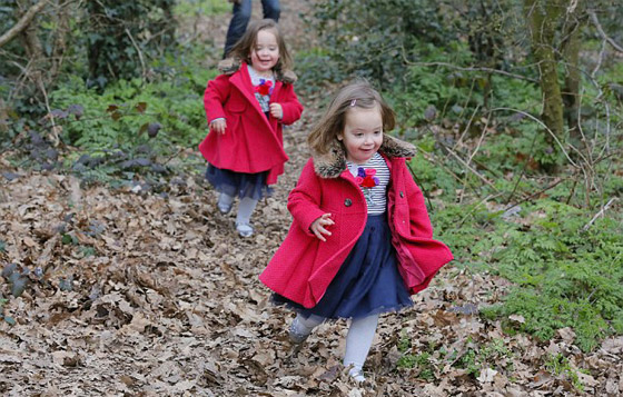 توأم ملتصق تتشابهان في كل شيء رغم فصلهما عند الولادة صورة رقم 10 توأم ملتصق تتشابهان في كل شيء رغم فصلهما عند الولادة صورة رقم 10