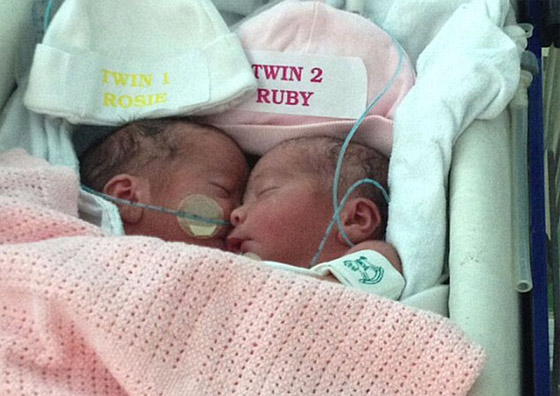 توأم ملتصق تتشابهان في كل شيء رغم فصلهما عند الولادة صورة رقم 2 توأم ملتصق تتشابهان في كل شيء رغم فصلهما عند الولادة صورة رقم 2