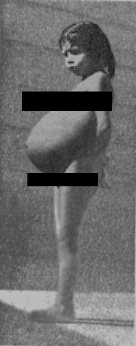 صور اصغر ام في التاريخ: وضعت مولوها وهي في سن 5 سنوات صورة رقم 3 صور اصغر ام في التاريخ: وضعت مولوها وهي في سن 5 سنوات صورة رقم 3