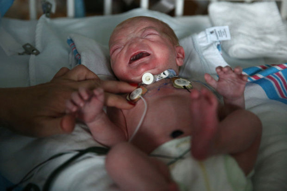 بالصور..طفل بدون انف يحل ضيفا مكرما على عالمنا ويستوطن ربوعه صورة رقم 2