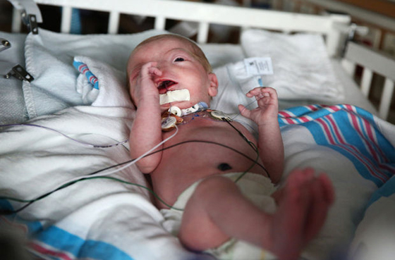 بالصور..طفل بدون انف يحل ضيفا مكرما على عالمنا ويستوطن ربوعه صورة رقم 22