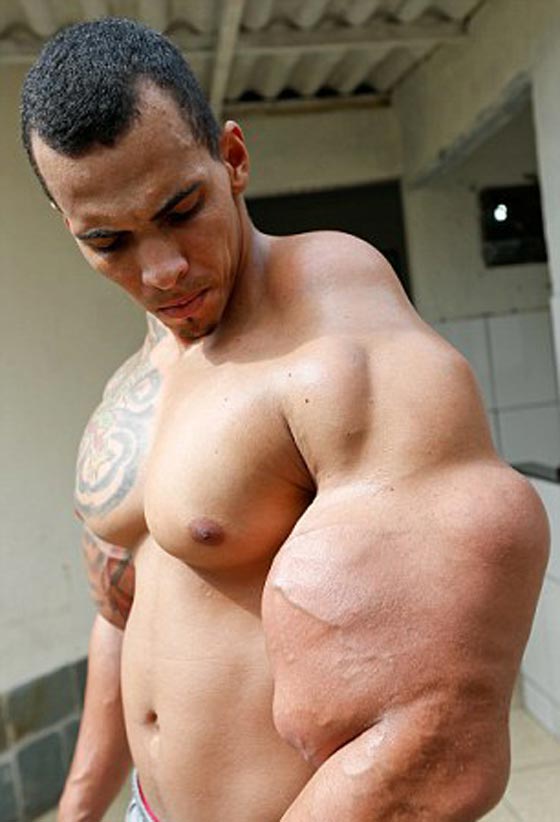 فيديو وصور برازيلي يحقن عضلاته بالزيت والكحول ويعرّض ذراعيه لخطر البتر صورة رقم 1