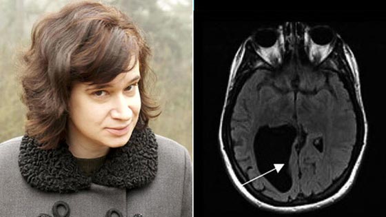 ثقب في دماغ امرأة جعلها خبيرة لغات لكنها لا تجيد تحديد الأبعاد! صورة رقم 1