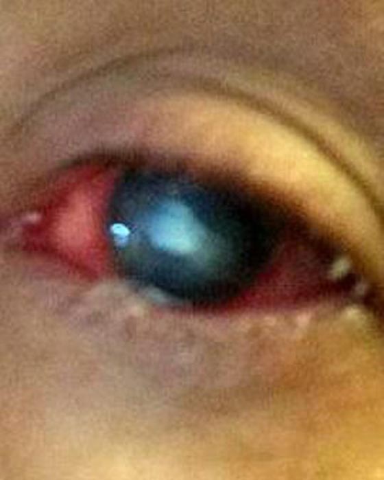 طفيلي يهاجم عين بريطانية ويحرمها من النوم سبعة ايام متتالية!! صورة رقم 3