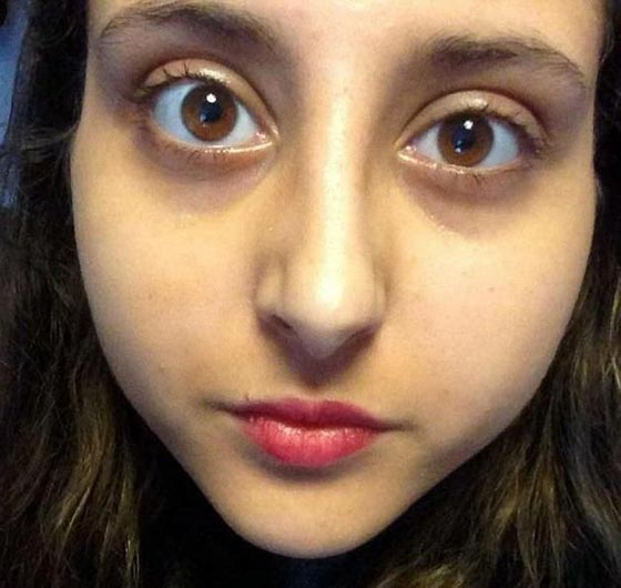 طفيلي يهاجم عين بريطانية ويحرمها من النوم سبعة ايام متتالية!! صورة رقم 1