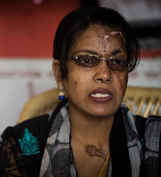 انتقاما من زوجته.. اب سكّير يرشق طفلته بمادة حارقة لتعيش مشوّهة! صورة رقم 7