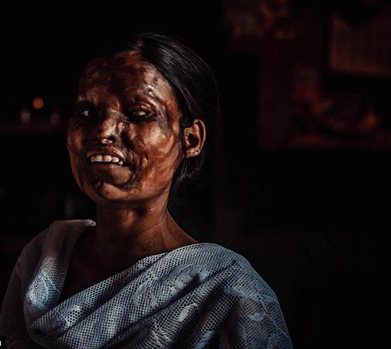 انتقاما من زوجته.. اب سكّير يرشق طفلته بمادة حارقة لتعيش مشوّهة! صورة رقم 3