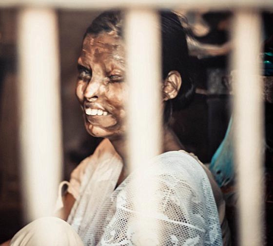 انتقاما من زوجته.. اب سكّير يرشق طفلته بمادة حارقة لتعيش مشوّهة! صورة رقم 4