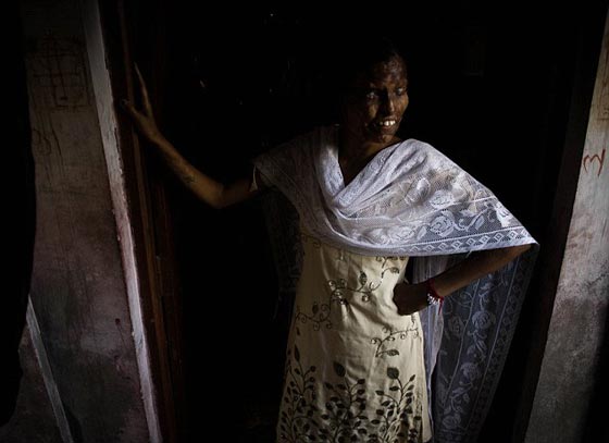 انتقاما من زوجته.. اب سكّير يرشق طفلته بمادة حارقة لتعيش مشوّهة! صورة رقم 5