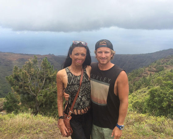 حب من الاساطير.. بقي وفيا لها رغم ان النار شوهت جمالها صورة رقم 12 حب من الاساطير.. بقي وفيا لها رغم ان النار شوهت جمالها صورة رقم 12