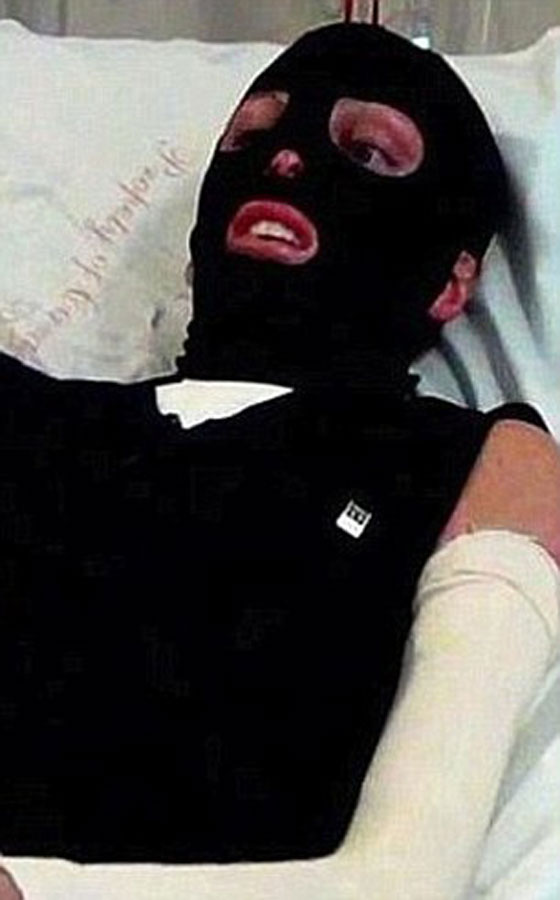 حب من الاساطير.. بقي وفيا لها رغم ان النار شوهت جمالها صورة رقم 4 حب من الاساطير.. بقي وفيا لها رغم ان النار شوهت جمالها صورة رقم 4