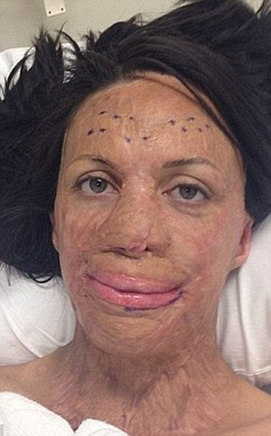 حب من الاساطير.. بقي وفيا لها رغم ان النار شوهت جمالها صورة رقم 3 حب من الاساطير.. بقي وفيا لها رغم ان النار شوهت جمالها صورة رقم 3