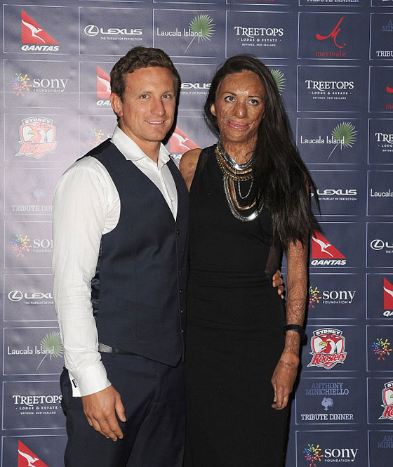 حب من الاساطير.. بقي وفيا لها رغم ان النار شوهت جمالها صورة رقم 9 حب من الاساطير.. بقي وفيا لها رغم ان النار شوهت جمالها صورة رقم 9