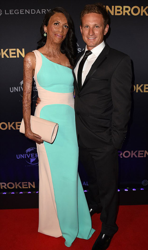 حب من الاساطير.. بقي وفيا لها رغم ان النار شوهت جمالها صورة رقم 8 حب من الاساطير.. بقي وفيا لها رغم ان النار شوهت جمالها صورة رقم 8