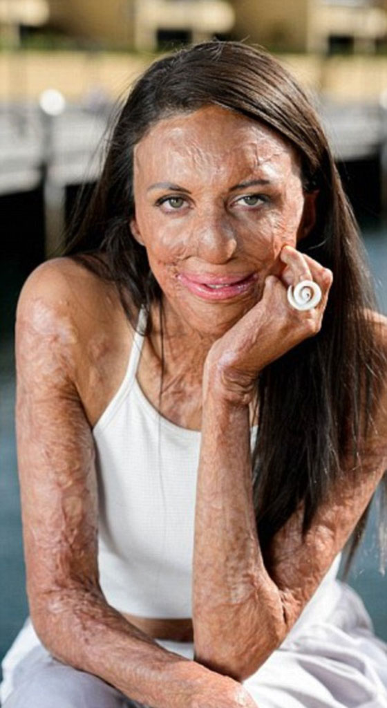 حب من الاساطير.. بقي وفيا لها رغم ان النار شوهت جمالها صورة رقم 1 حب من الاساطير.. بقي وفيا لها رغم ان النار شوهت جمالها صورة رقم 1