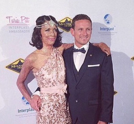 حب من الاساطير.. بقي وفيا لها رغم ان النار شوهت جمالها صورة رقم 6 حب من الاساطير.. بقي وفيا لها رغم ان النار شوهت جمالها صورة رقم 6