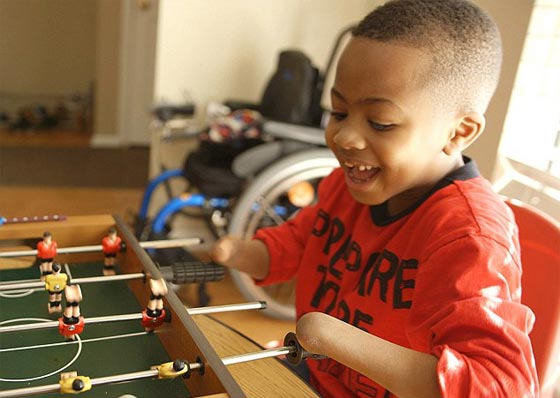 اول مرة في العالم.. عملية زرع يدين لطفل امريكي تتكلل بالنجاح صورة رقم 4 اول مرة في العالم.. عملية زرع يدين لطفل امريكي تتكلل بالنجاح صورة رقم 4