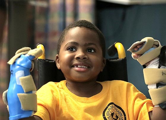 اول مرة في العالم.. عملية زرع يدين لطفل امريكي تتكلل بالنجاح صورة رقم 7 اول مرة في العالم.. عملية زرع يدين لطفل امريكي تتكلل بالنجاح صورة رقم 7