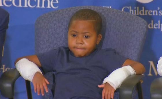 اول مرة في العالم.. عملية زرع يدين لطفل امريكي تتكلل بالنجاح صورة رقم 15 اول مرة في العالم.. عملية زرع يدين لطفل امريكي تتكلل بالنجاح صورة رقم 15