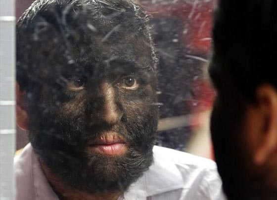 بالصور.. عائلة الذئاب في المكسيك 31 فردا يغطيهم الشعر الكثيف صورة رقم 4