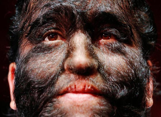 بالصور.. عائلة الذئاب في المكسيك 31 فردا يغطيهم الشعر الكثيف صورة رقم 5