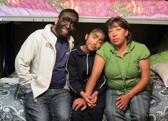 بالصور.. عائلة الذئاب في المكسيك 31 فردا يغطيهم الشعر الكثيف صورة رقم 6