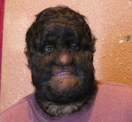 بالصور.. عائلة الذئاب في المكسيك 31 فردا يغطيهم الشعر الكثيف صورة رقم 11