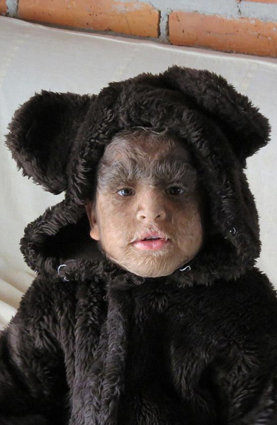 بالصور.. عائلة الذئاب في المكسيك 31 فردا يغطيهم الشعر الكثيف صورة رقم 24