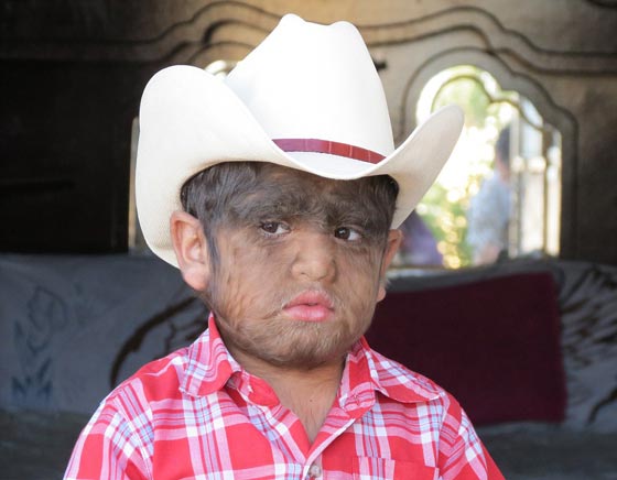 بالصور.. عائلة الذئاب في المكسيك 31 فردا يغطيهم الشعر الكثيف صورة رقم 25