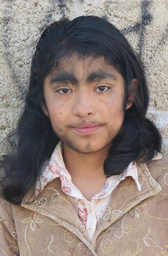 بالصور.. عائلة الذئاب في المكسيك 31 فردا يغطيهم الشعر الكثيف صورة رقم 27