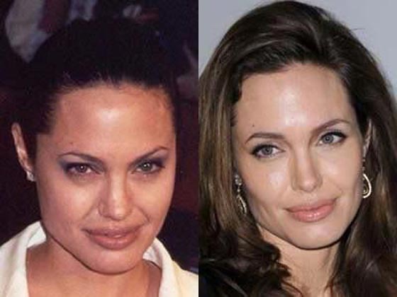 صور فنانات قبل وبعد البوتوكس تؤكد عودة شبابهن وجمالهن واختفاء تجاعيد الوجه صورة رقم 14