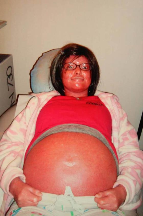 فيديو وصور: امرأة مصابة بمرض جلدي نادر تصبح اما وتدهش الأطباء صورة رقم 6