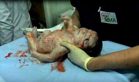 الجنين السوري امل تحدى الصواريخ وولد ليرى النور صورة رقم 3