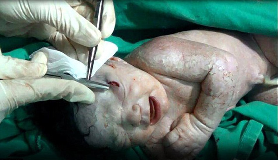 الجنين السوري امل تحدى الصواريخ وولد ليرى النور صورة رقم 2