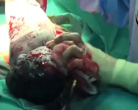 الجنين السوري امل تحدى الصواريخ وولد ليرى النور صورة رقم 4