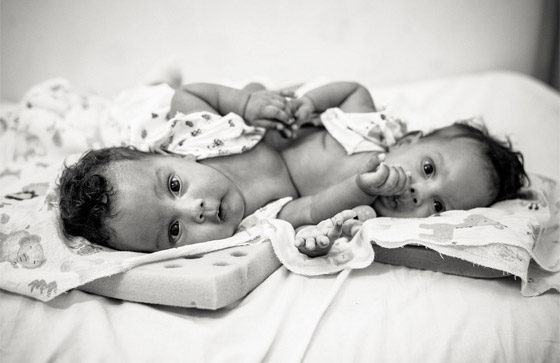 مصور يتتبع حالة طفلتين ملتصقتين حتى انفصالهما جسديا صورة رقم 1