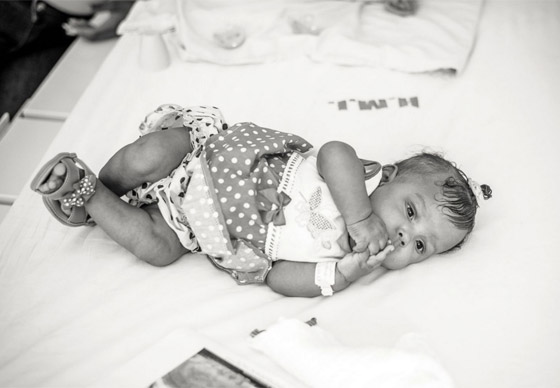 مصور يتتبع حالة طفلتين ملتصقتين حتى انفصالهما جسديا صورة رقم 10