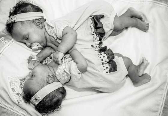 مصور يتتبع حالة طفلتين ملتصقتين حتى انفصالهما جسديا صورة رقم 2