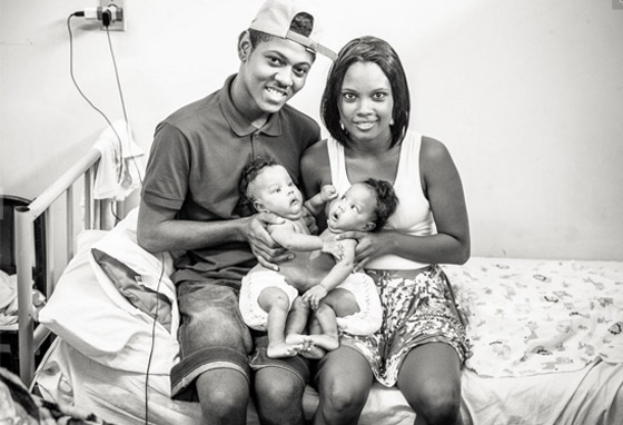 مصور يتتبع حالة طفلتين ملتصقتين حتى انفصالهما جسديا صورة رقم 5