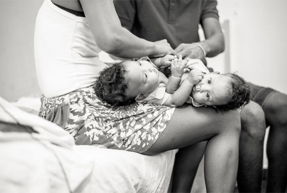 مصور يتتبع حالة طفلتين ملتصقتين حتى انفصالهما جسديا صورة رقم 3