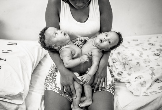 مصور يتتبع حالة طفلتين ملتصقتين حتى انفصالهما جسديا صورة رقم 4