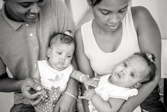 مصور يتتبع حالة طفلتين ملتصقتين حتى انفصالهما جسديا صورة رقم 8