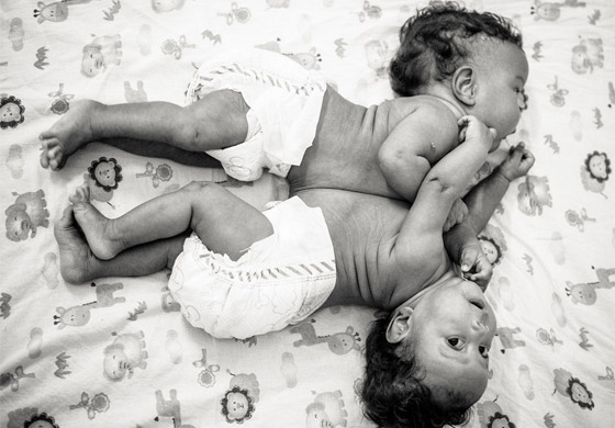 مصور يتتبع حالة طفلتين ملتصقتين حتى انفصالهما جسديا صورة رقم 6