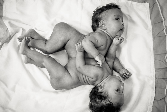 مصور يتتبع حالة طفلتين ملتصقتين حتى انفصالهما جسديا صورة رقم 7