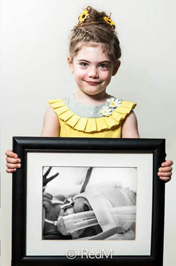 هكذا كنت خديجا.. معرض صور لاطفال عاشوا بعد ولادة مبكرة صورة رقم 4 هكذا كنت خديجا.. معرض صور لاطفال عاشوا بعد ولادة مبكرة صورة رقم 4