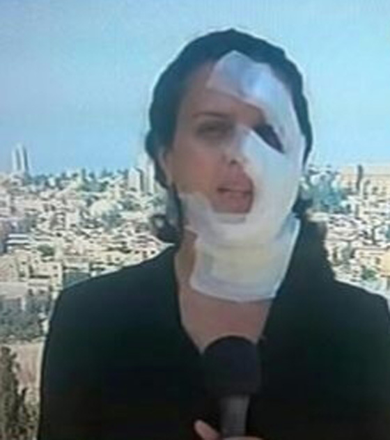 اصابة مراسلة قناة الميادين الصحفية هناء محاميد.. لحظة اثر لحظة صورة رقم 1 اصابة مراسلة قناة الميادين الصحفية هناء محاميد.. لحظة اثر لحظة صورة رقم 1