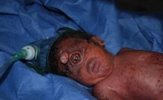 مولود بعين واحدة في وسط الجبين وبدون انف في مصر صورة رقم 1 مولود بعين واحدة في وسط الجبين وبدون انف في مصر صورة رقم 1